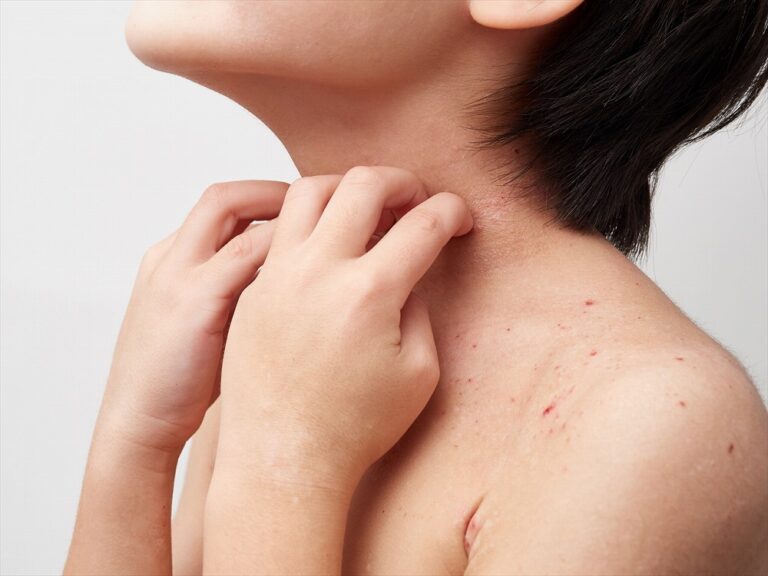 アトピー性皮膚炎の予防方法